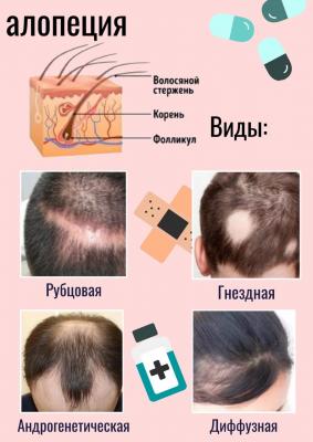 Очаговая алопеция - Cosmedica Clinic - Dr. Levent Acar